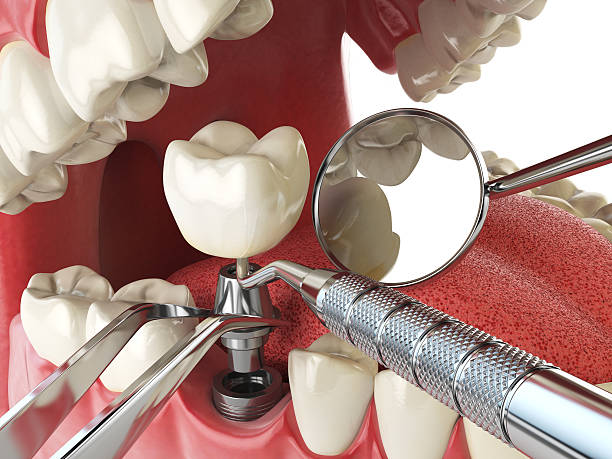 Best Emergency Dental Care for Broken or Chipped Teeth in Landrum, SC